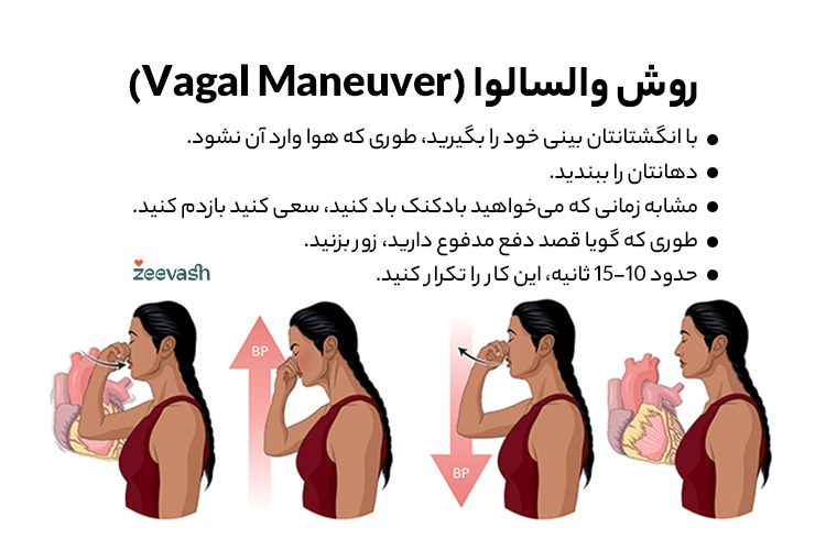 روش والسالوا (Vagal Maneuver)